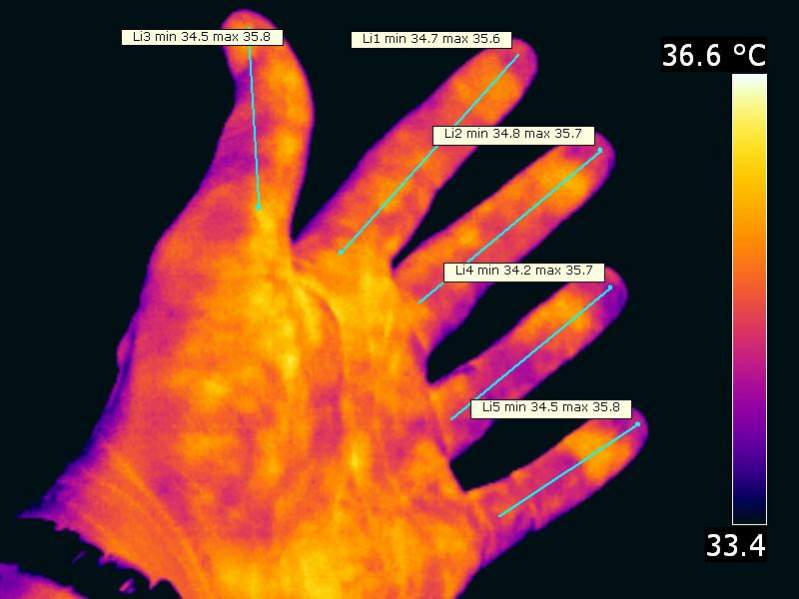 Eine (meine) ;-) linke Hand. So sieht bei normaler Raumtemperatur die Temperaturverteilung einer gesunden Hand aus. Gewisse (aber natürlich bei weitem nicht alle!) Erkrankungen manifestieren sich auch in der Wärmesignatur. So erscheinen beispielsweise Ent
